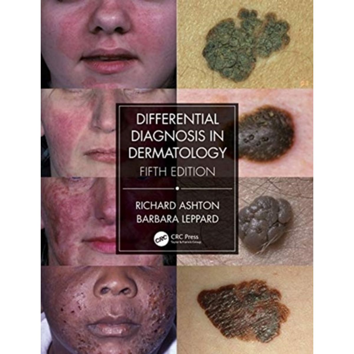 Differential Diagnosis in Dermatology