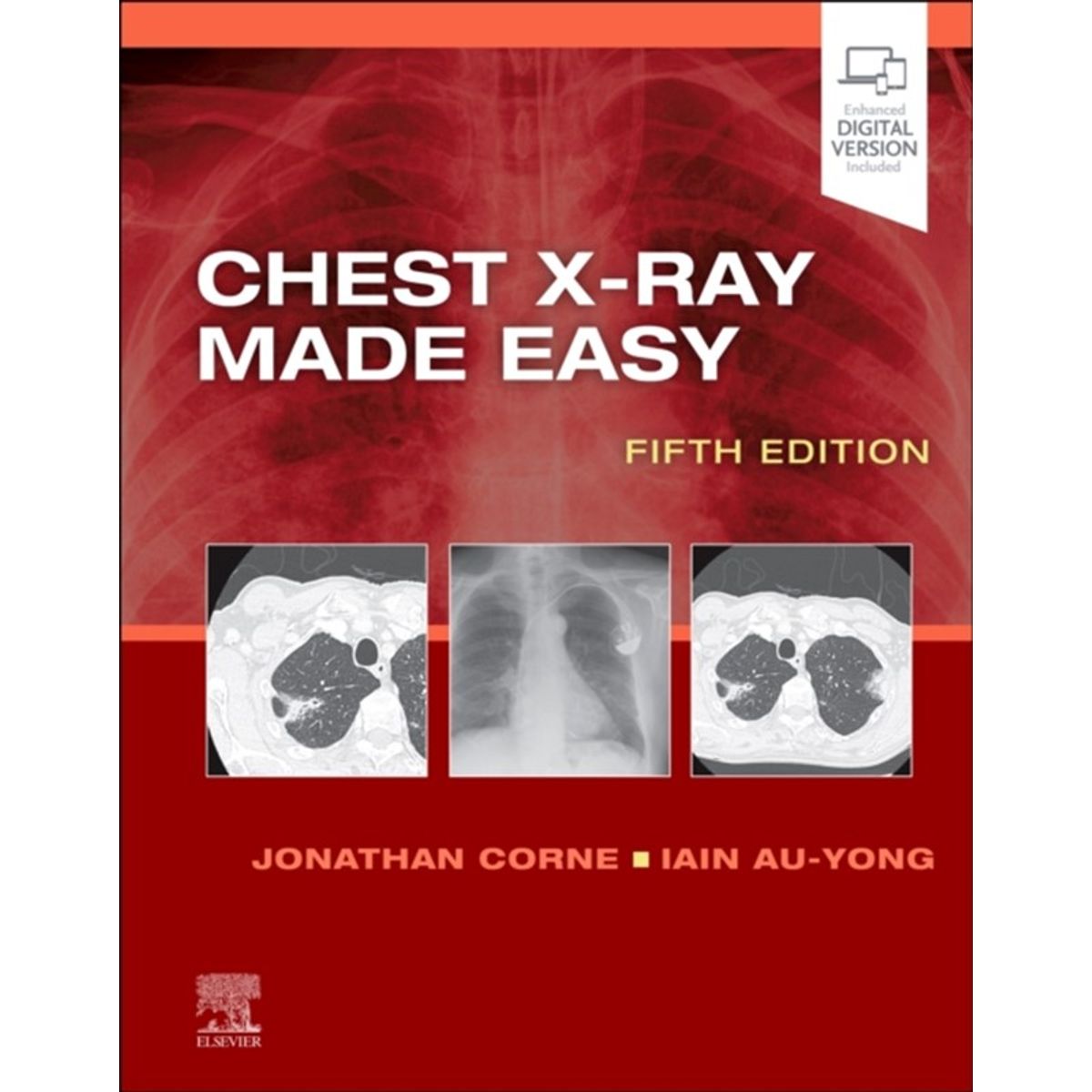 Chest X-Ray Made Easy